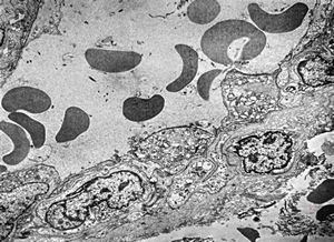 F,6m. | capillary hemangioma - hard palate F,6m. | capillary hemangioma - hard palate
